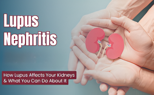 Lupus Nephritis