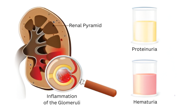 Understanding Glomerulonephritis